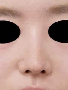 鼻中隔延長 正面 1か月後