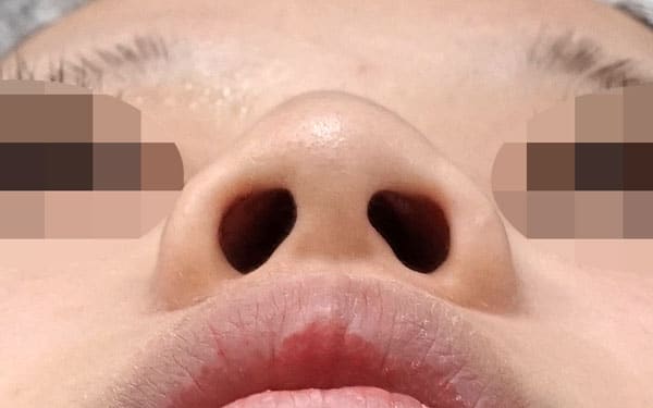 鼻翼縮小（内側法＋外側法）、プロテーゼ入れ替え　３ヶ月後　下からのBefore写真