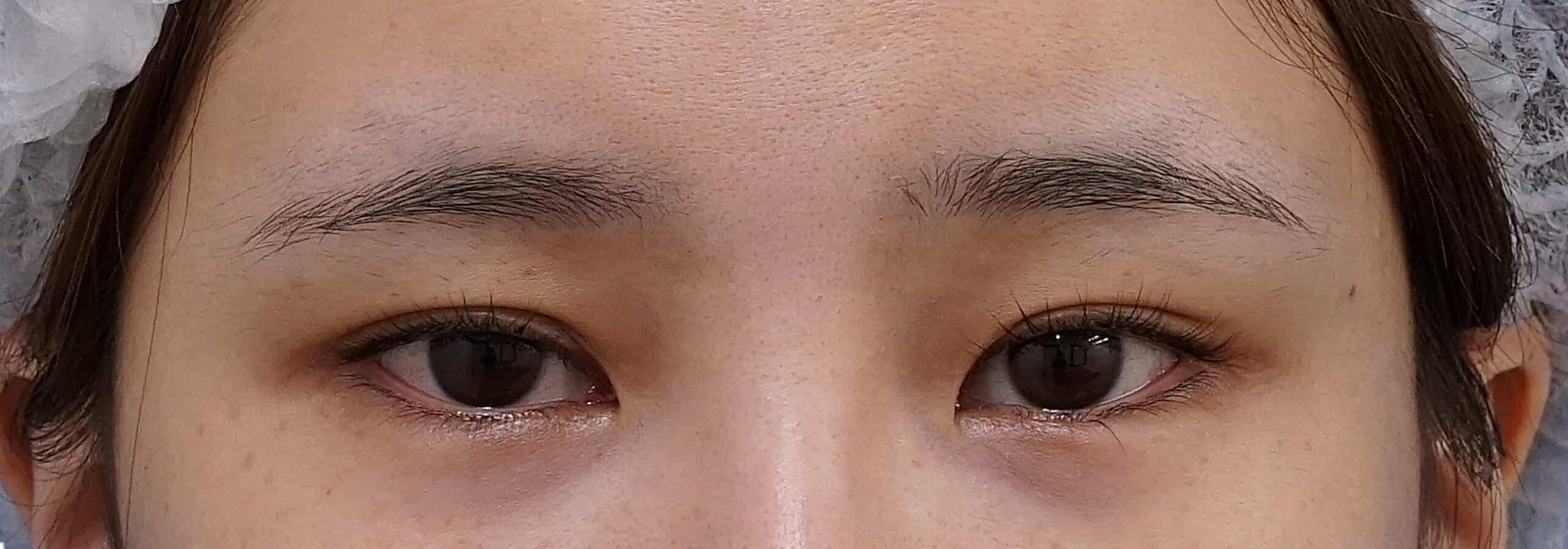 眉下切開 術後3か月のBefore写真
