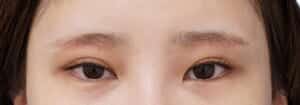 眉下切開 術後1か月