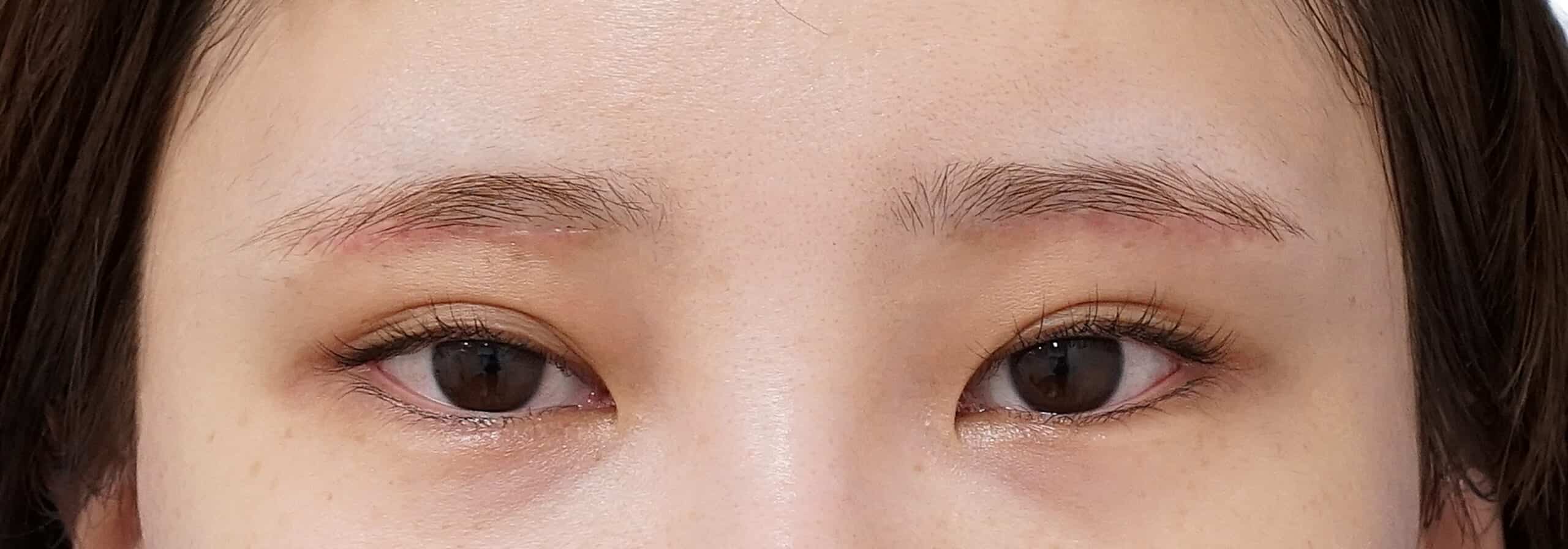 眉下切開 術後1か月のAfterの写真