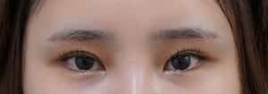 眉下切開 術後3か月