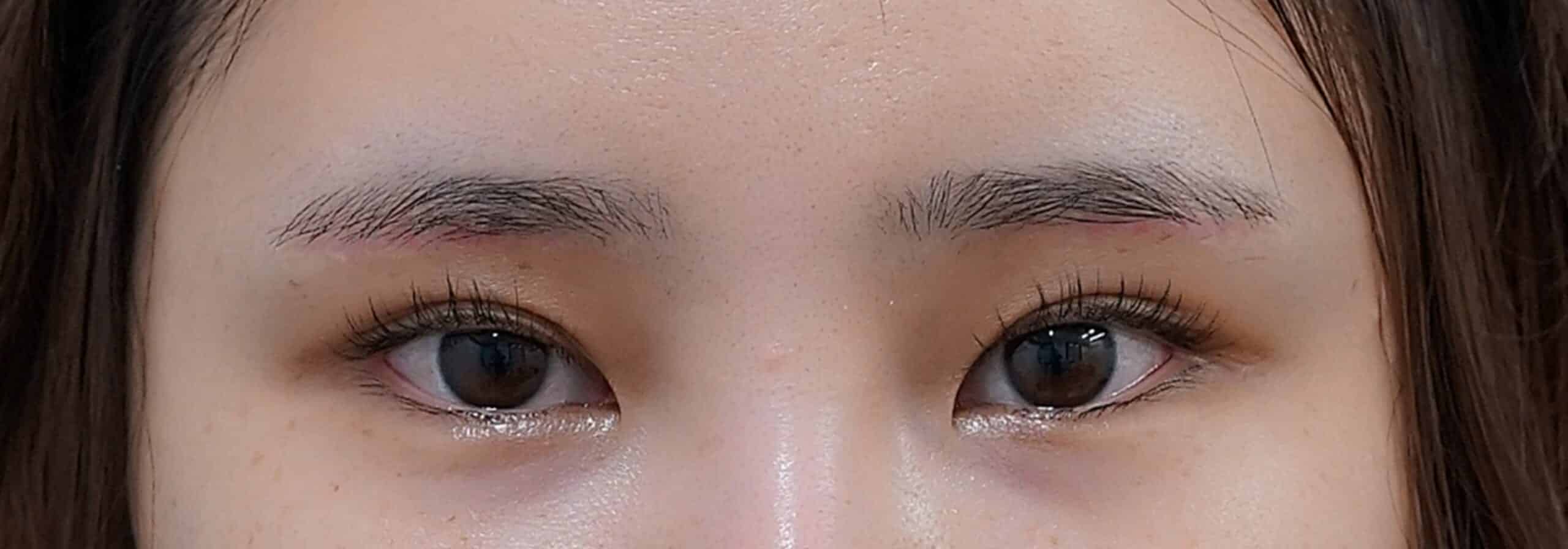 眉下切開 術後3か月のAfterの写真