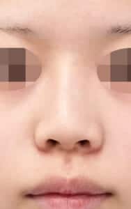 小鼻縮小(内側+外側)、プロテーゼ入れ替え 手術前 正面