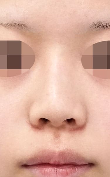 鼻翼縮小（内側法＋外側法）、プロテーゼ入れ替え　３ヶ月後　正面のBefore写真