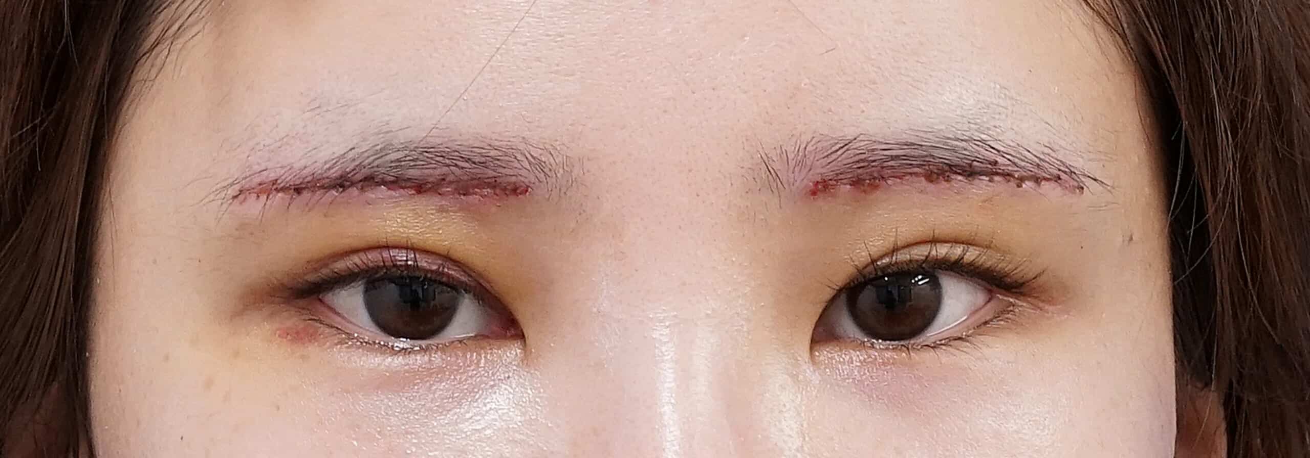 眉下切開 術後5日（抜糸直後）のAfterの写真