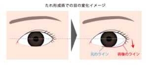 たれ目形成での目の変化のイメージ