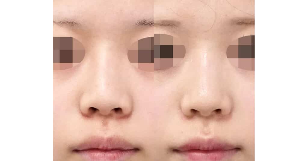 小鼻を小さくしてすっきりさせる｜鼻翼縮小（内側法＋外側法）、プロテーゼ入れ替え　３ヶ月後