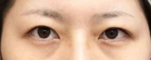 眉下切開（目の上たるみ取り）　手術前
