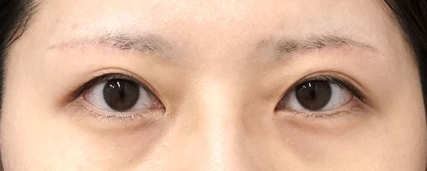 眉下切開　3ヶ月後のAfterの写真