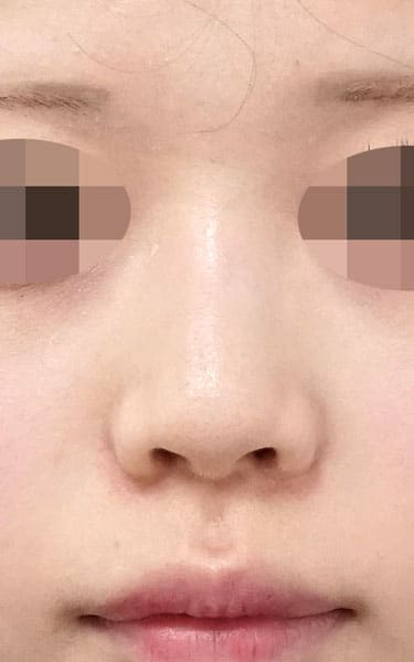 鼻翼縮小（内側法＋外側法）、プロテーゼ入れ替え　３ヶ月後　正面のAfterの写真