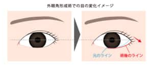 外眼角形成術での目の変化イメージ