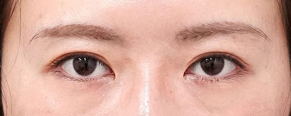 睫毛側たるみ取り　３ヶ月後のAfterの写真