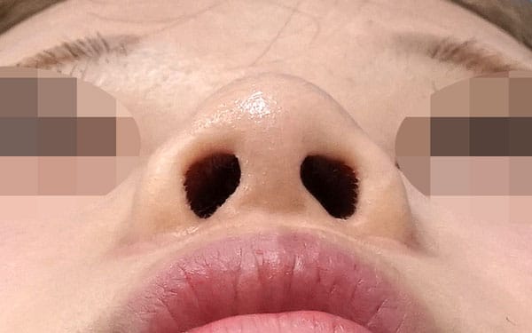鼻翼縮小（内側法＋外側法）、プロテーゼ入れ替え　３ヶ月後　下からのAfterの写真