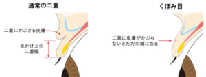くぼみ目の構造2(断面図)