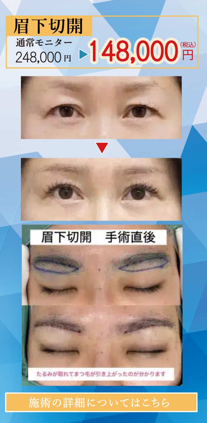 2025.8　美容整形格安モニター募集４