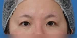 目頭切開+眉下切開 術前