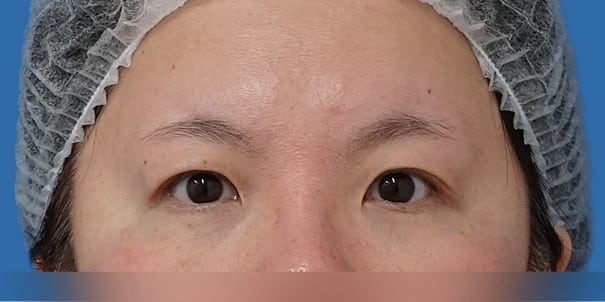 目頭切開（Z形成）＋眉下切開 術後6か月のBefore写真