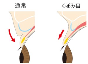 くぼみ目力の方向(断面図)