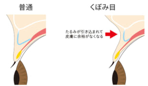 くぼみ目の構造(断面図)