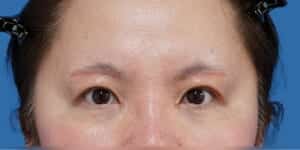 目頭切開+眉下切開 術後1か月