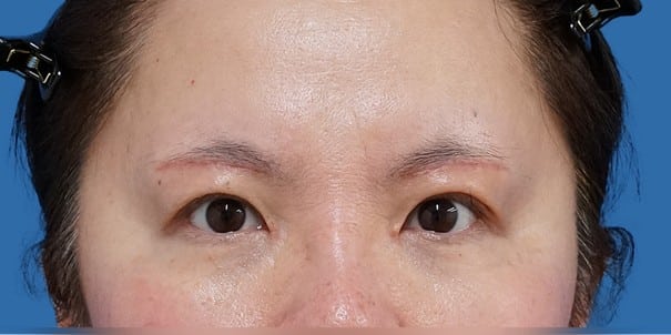 目頭切開（Z形成）＋眉下切開 術後1か月のAfterの写真