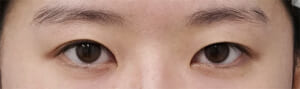 埋没法末広型症例写真 術前
