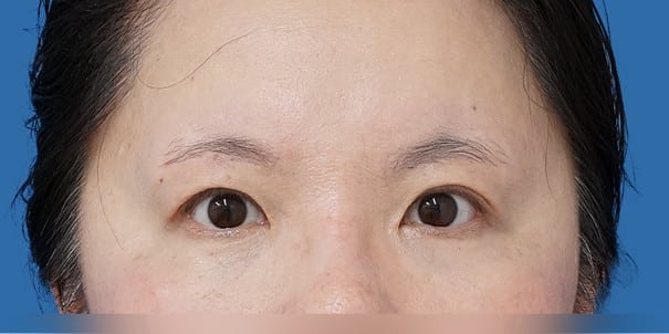 目頭切開（Z形成）＋眉下切開 術後6か月のAfterの写真