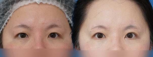 目頭切開＋眉下切開で、自然に大きく明るい目元へ