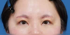 目頭切開+眉下切開 抜糸直後