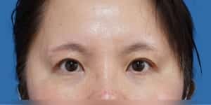 目頭切開+眉下切開 術後3か月