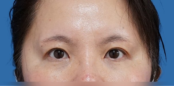 目頭切開（Z形成）＋眉下切開 術後3か月のAfterの写真