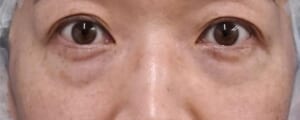 くまとり（目の下脂肪取り・脂肪注入）　手術前