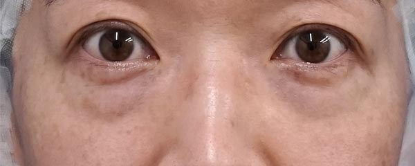 目の下脂肪取り・コンデンス脂肪注入 3ヶ月後のBefore写真