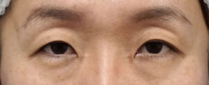 切る眼瞼下垂　術前