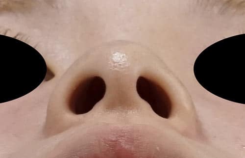 鼻尖縮小・軟骨移植・ストラット　６ヶ月後　下からのBefore写真