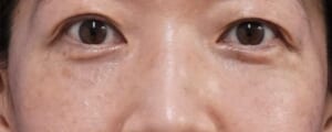 くまとり（目の下脂肪取り・脂肪注入）　１ヶ月後