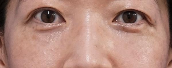 目の下脂肪取り・コンデンス脂肪注入　１ヶ月後のAfterの写真