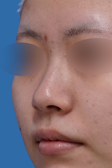 切らない鼻尖延長（ミスコ 8本） 斜め 1か月後のBefore写真
