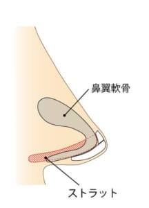 耳介軟骨移植(ストラット)断面