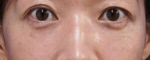 くまとり（目の下脂肪取り・脂肪注入）　３ヶ月後