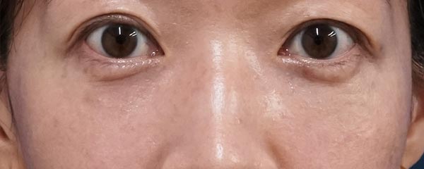 目の下脂肪取り・コンデンス脂肪注入 3ヶ月後のAfterの写真
