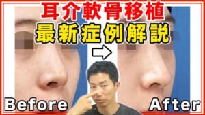 【鼻整形】耳介軟骨移植の効果を最新の症例写真をご紹介して解説【美容医療】