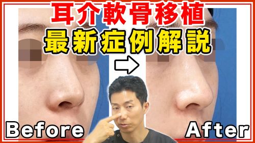 【鼻整形】耳介軟骨移植の効果を最新の症例写真で解説【美容医療】