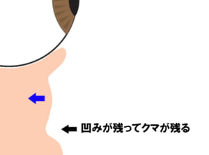 目の下脂肪とりのみおこなった場合