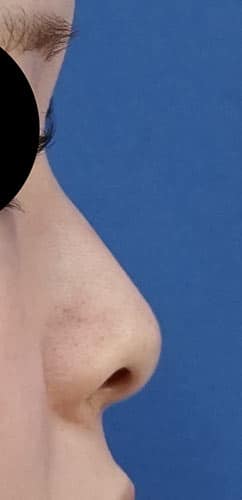 鼻尖縮小・軟骨移植・ストラット　６ヶ月後　右側面のBefore写真