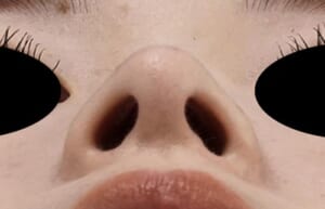 鼻尖縮小・軟骨移植・ストラット 6ヶ月後 下から