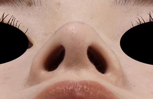 鼻尖縮小・軟骨移植・ストラット　６ヶ月後　下からのAfterの写真