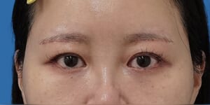 眉下切開 術後1か月 正面