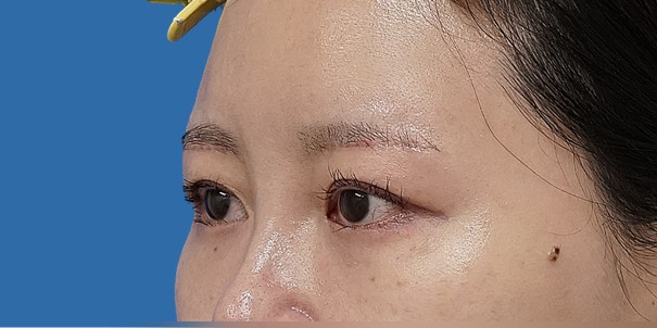 眉下切開 術後1か月のAfterの写真